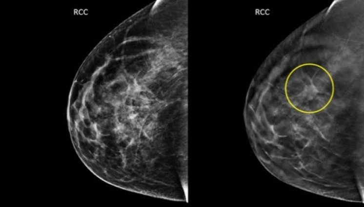 Prevenção Oncológica. Tomossíntese Mamária